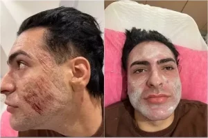 Vítima morreu em clínica ao inalar fenol durante peeling, diz laudo